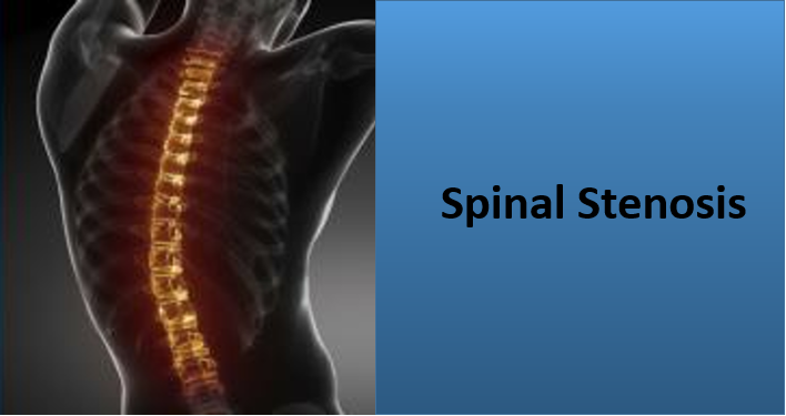 What is Spinal Stenosis? Causes, Symptoms and Treatment Options