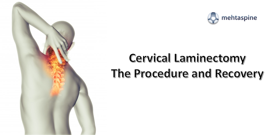 Cervical Laminectomy treatment - Mehtaspine