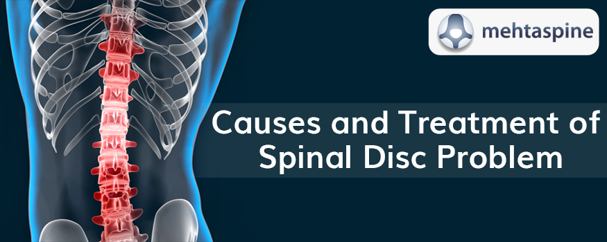 Treatment for Spinal Disc Problems | spinal specialist doctor in uk