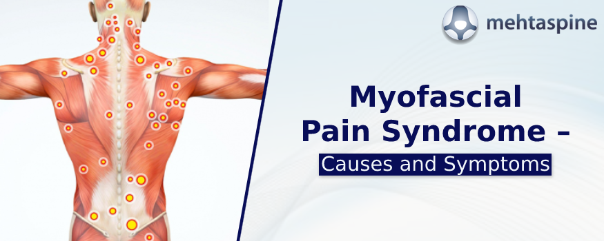how i cured my myofascial pain syndrome