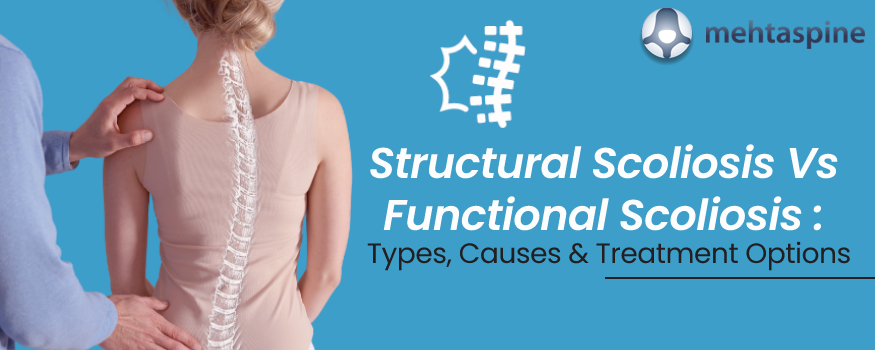 Functional vs Structural Scoliosis