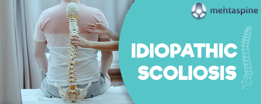 IDIOPATHIC SCOLIOSIS