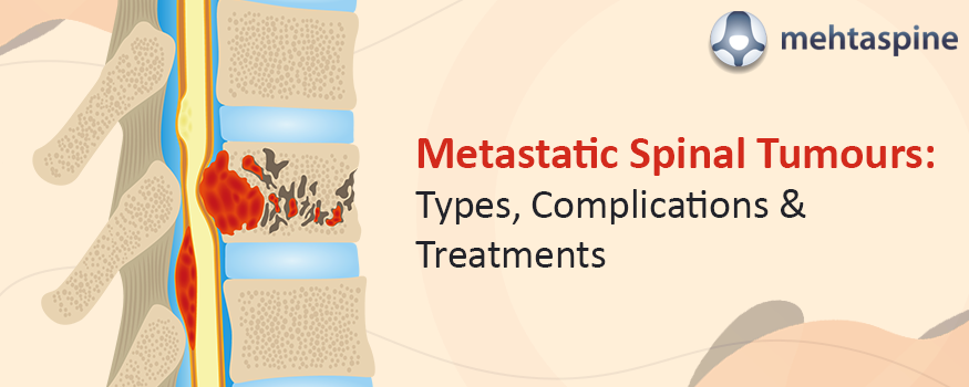 metastatic spinal tumours
