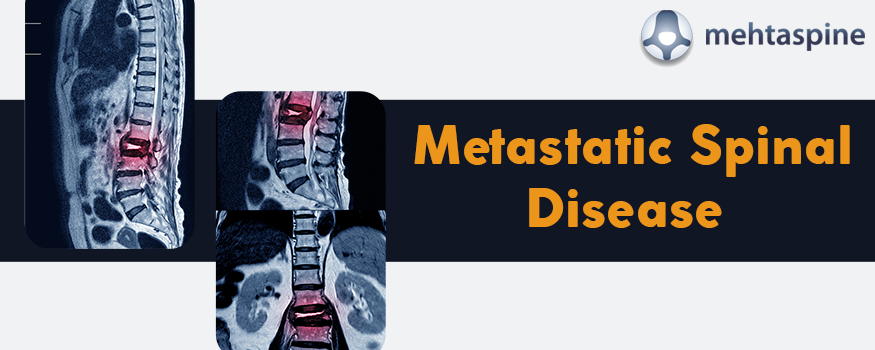metastatic disease of the spine