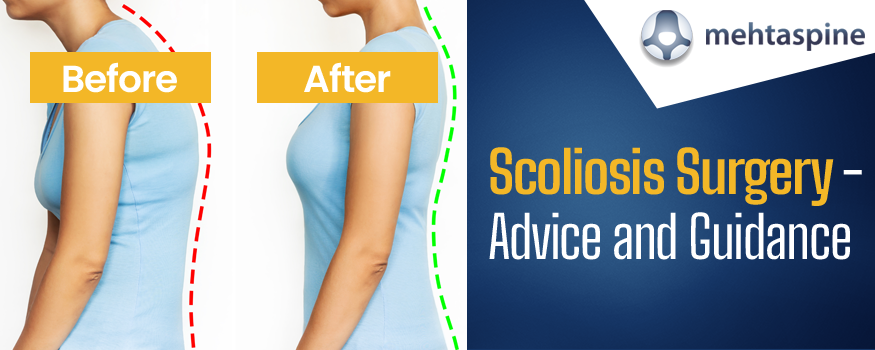 Before-and-After-Scoliosis-Surgery-Advice-and-Guidance