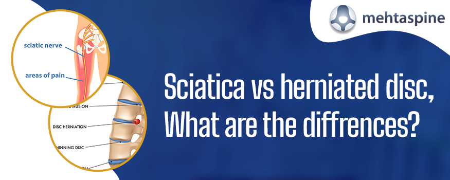 Sciatica vs herniated disc,What are the diffrences