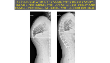 Anterior and Posterior Correction - Mehtaspine