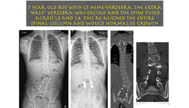 Congenital Scoliosis – Dr.Jwalant S Mehta.