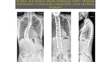 Early onset Scoliosis- Jwalant Mehta