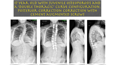 Posterior Correction – Mehtaspine.