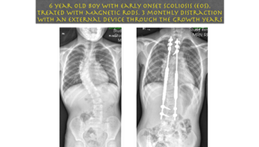 Posterior Correction - MehtaSpine