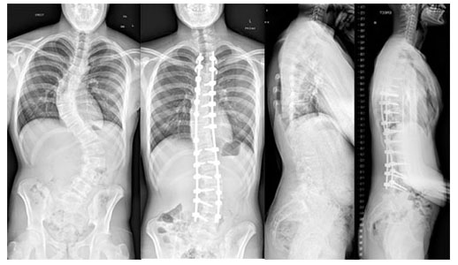 spinal deformity x-ray